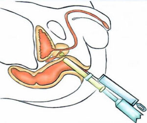 Biopsia transrettale