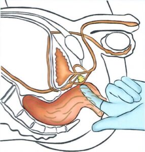 ESPLORAZIONE RETTALE
